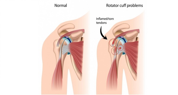 tendonitis