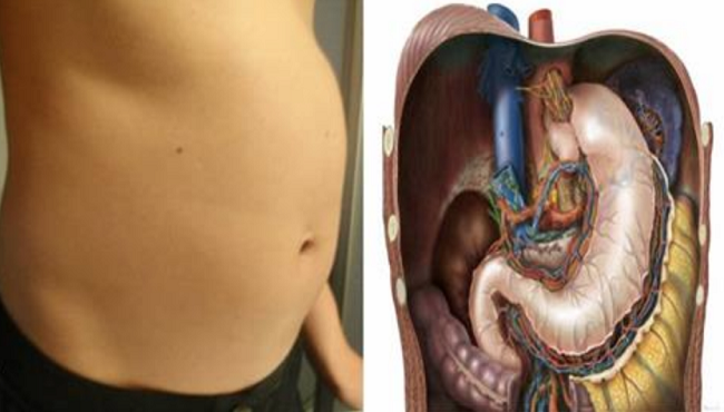 8 Causes Of Bloated Stomach and Natural Remedies