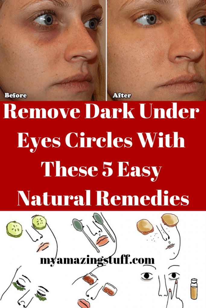 Remove Dark Under Eyes Circles With These 5 Easy Natural Remedies