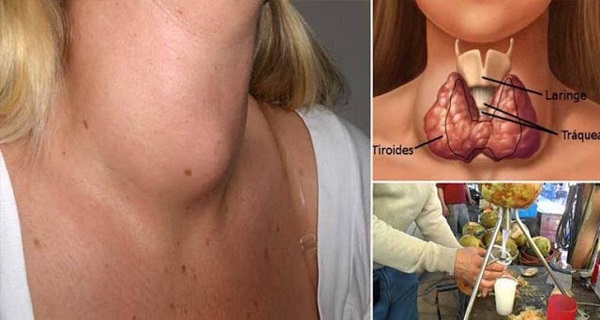 Doctors Will Never Tell You This: Here’s How To Cure Your Thyroid Gland With Just One Ingredient!